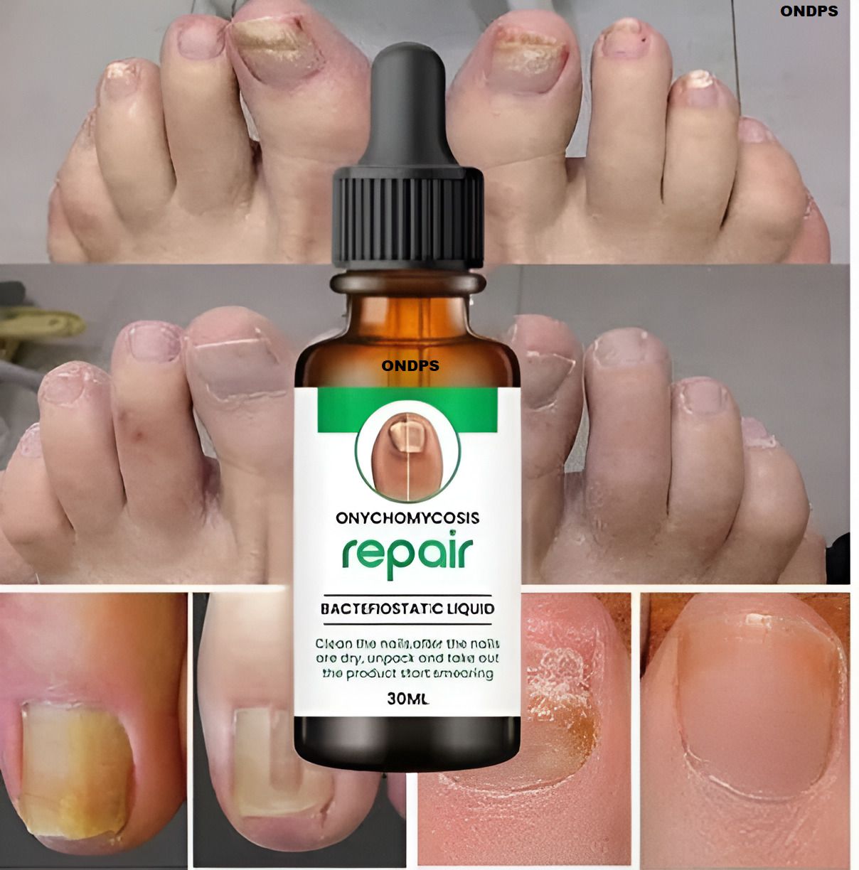 ondps Nail Serum - Boost Nail Growth, Strong and Repair Nails - Pack of 1 nail growth serum-picture-48