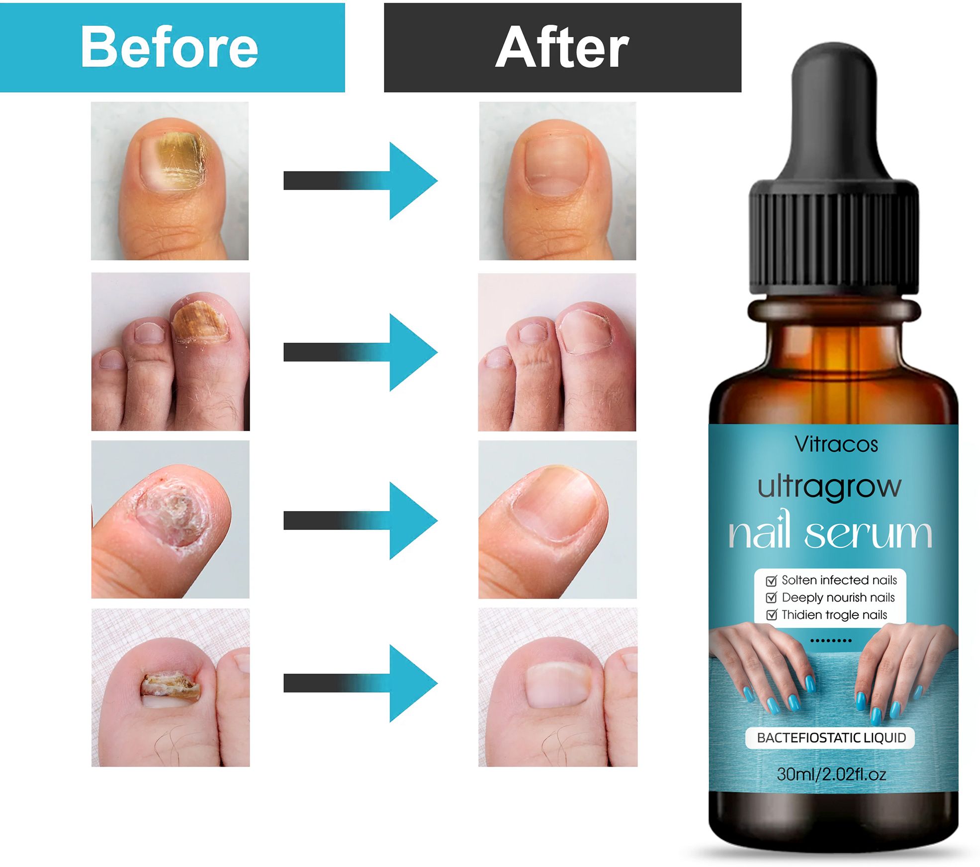 Ultragrow Nail Serum for Fungal Infection & Growth Blue