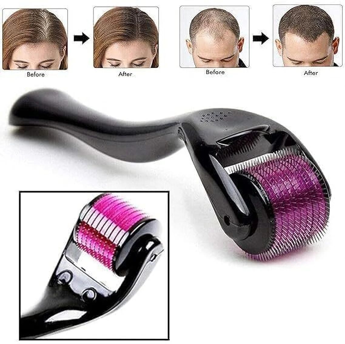 Derma Roller 0.5mm for Acne Scars, Anti Aging, 540 Titanium Needle-image-1