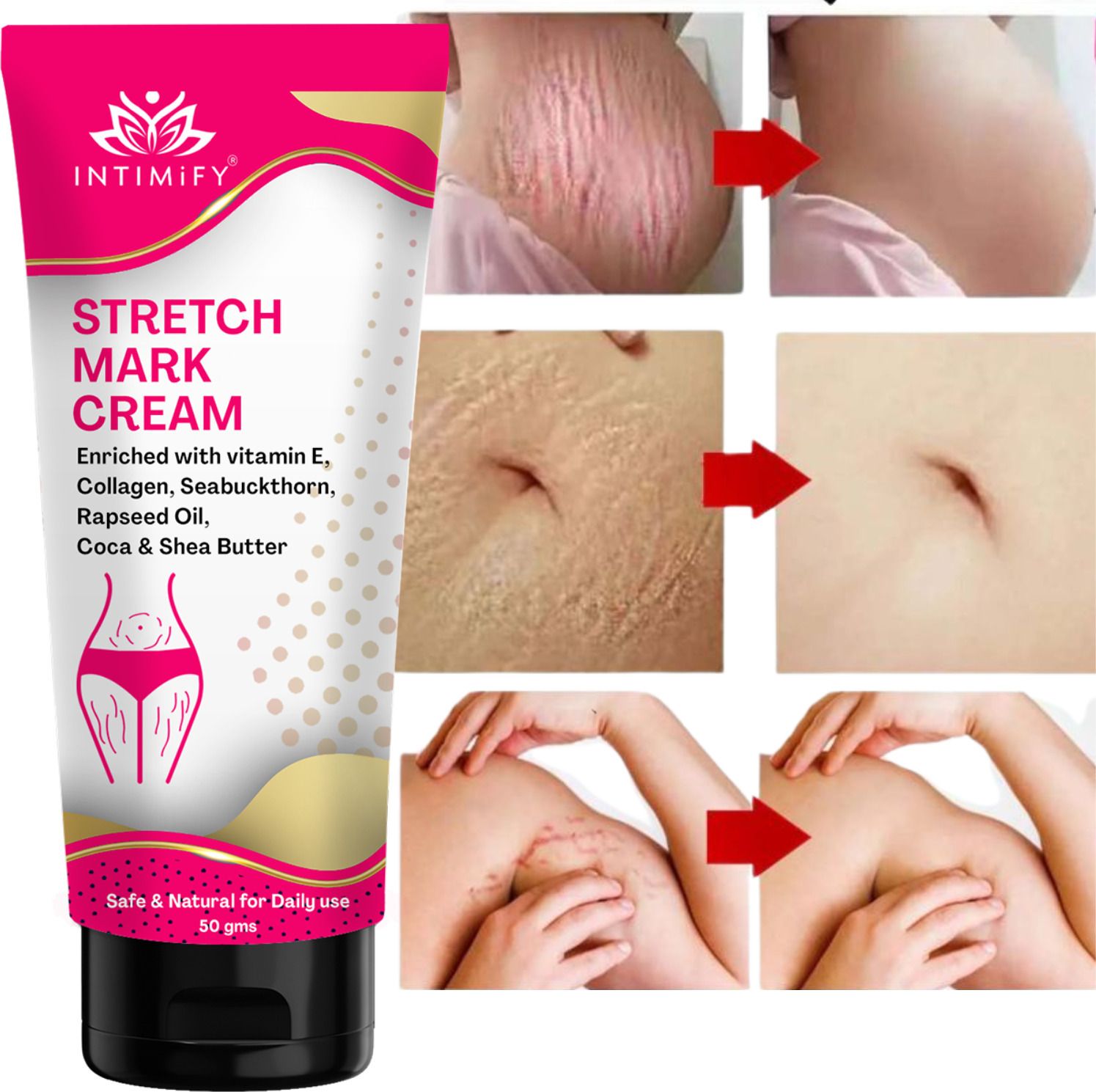 intimify Stretch Marks Removal Cream, In During After Pregnancy Delivery-picture-8